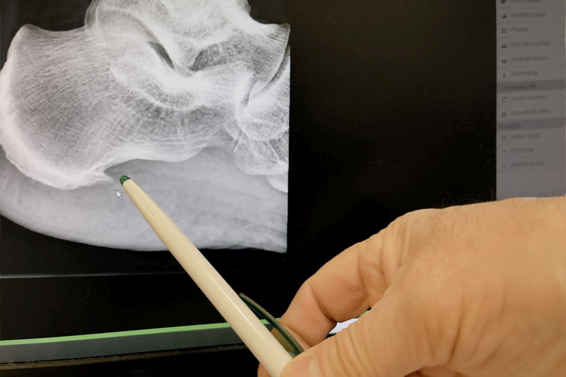 Arzt zeigt mit Stift auf sichtbarem Fersensporn auf einer Röntgenaufnahme